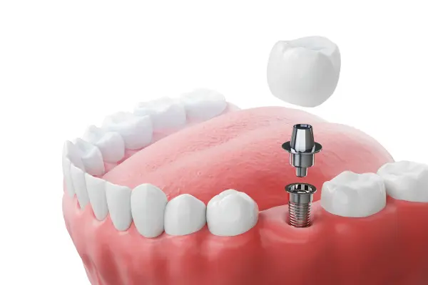 3d-implant-abutment-and-crown-assembly