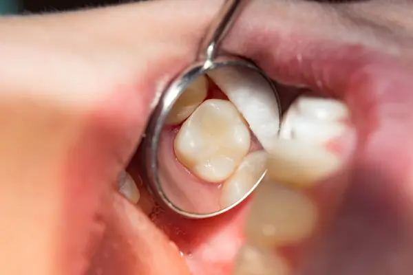 dental-mirror-reflecting-molar-tooth-closeup